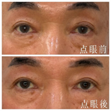 BBL治療施術間隔